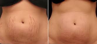 Stretch Marks Multiple Therapy